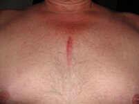 chest wound.jpg